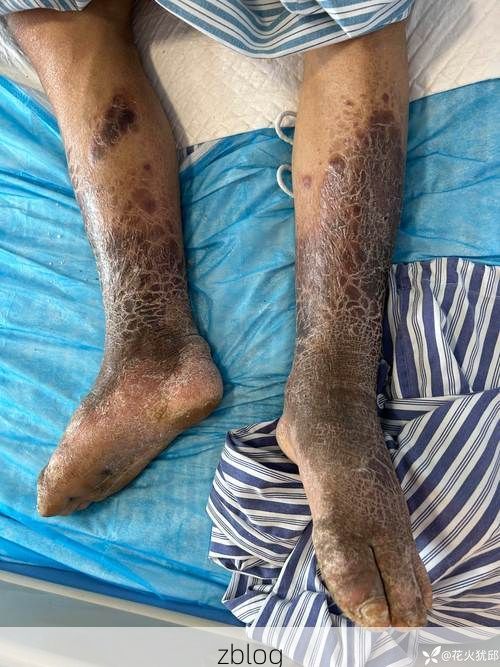 天等：桂西喀斯特屏障下的低感染样本